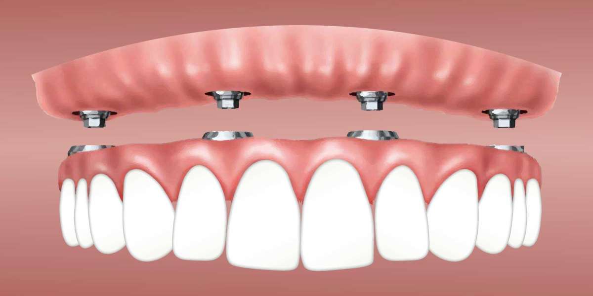 Dental Implants and Invisalign: A Comprehensive Overview