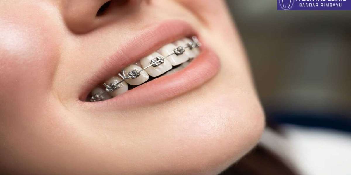 Expertise in Clear Aligner Technology: The Invisible Braces Dentist
